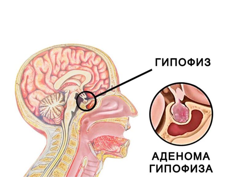 Подробнее о статье Аденома гипофиза